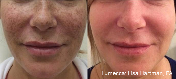 lumecca-before-after-dr-l-hartman-preview-2