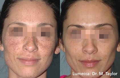 lumecca-before-after-dr-m-taylor-preview-3