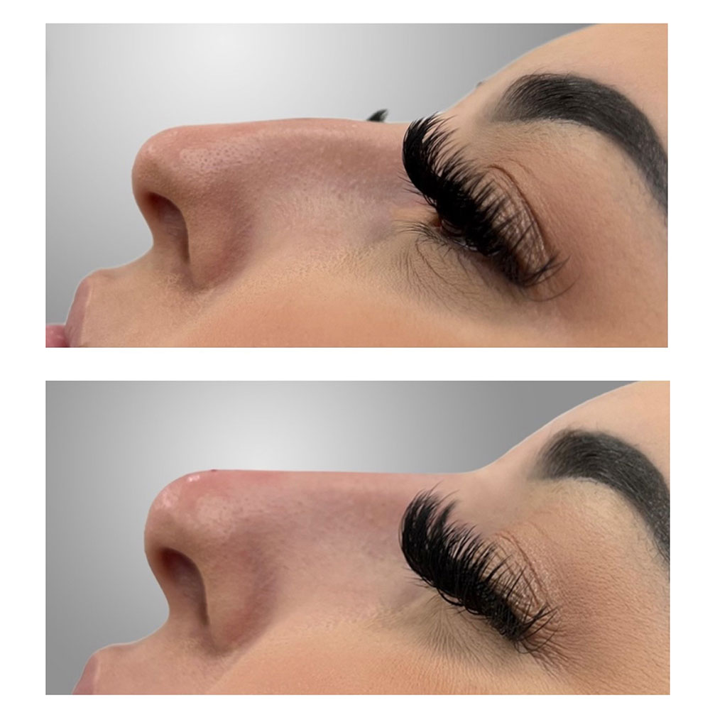 nonsurgical nose job rhinoplasty juvederm in corona, ca