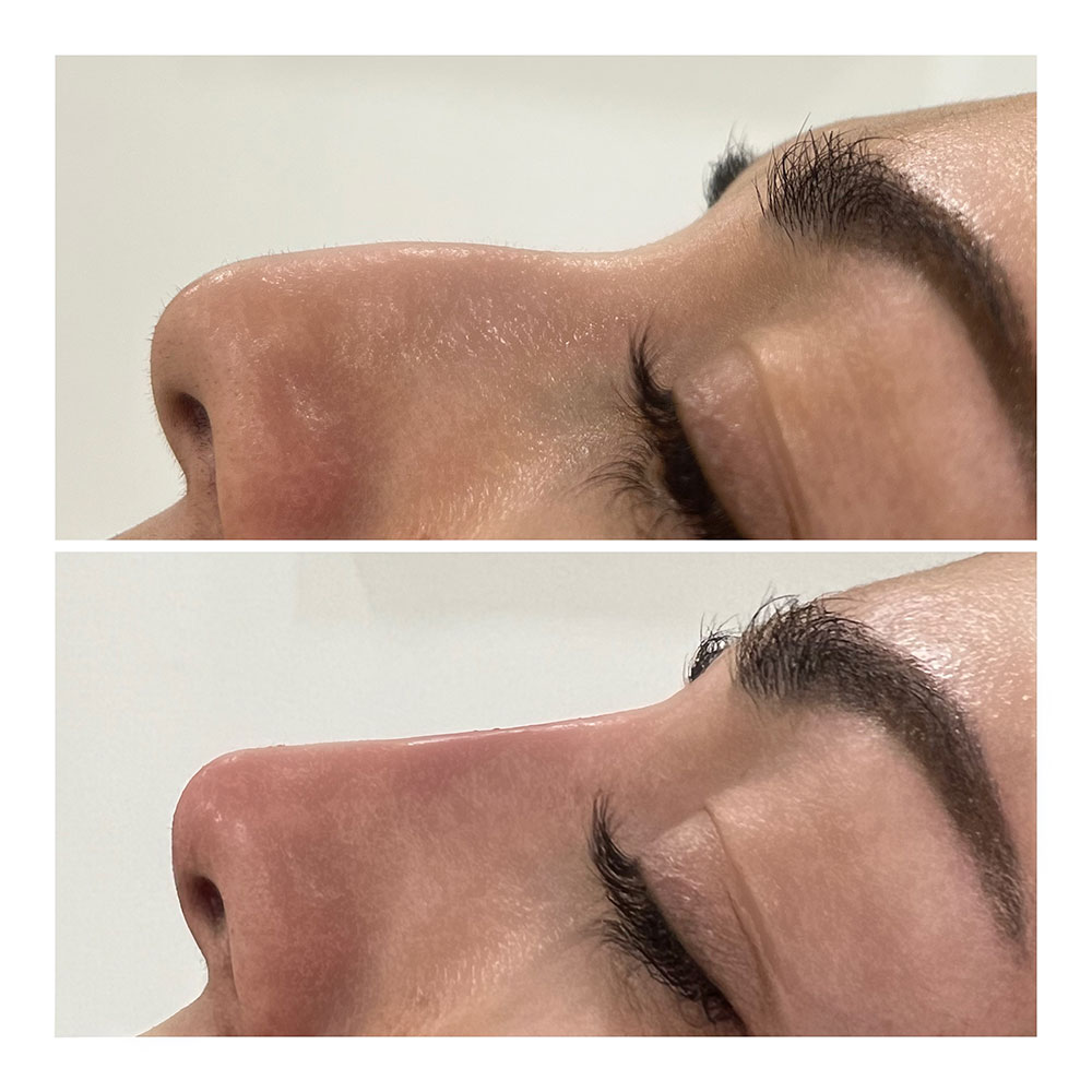 nonsurgical nose job rhinoplasty Juvéderm in corona, ca