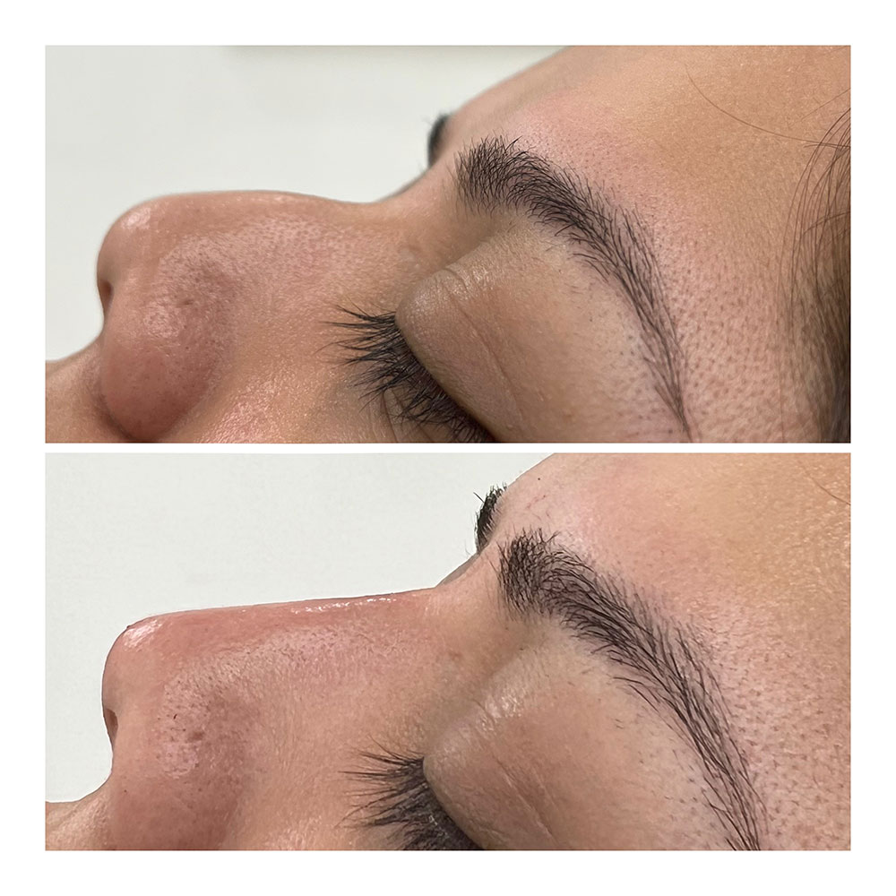 nonsurgical nose job rhinoplasty juvederm in corona, ca