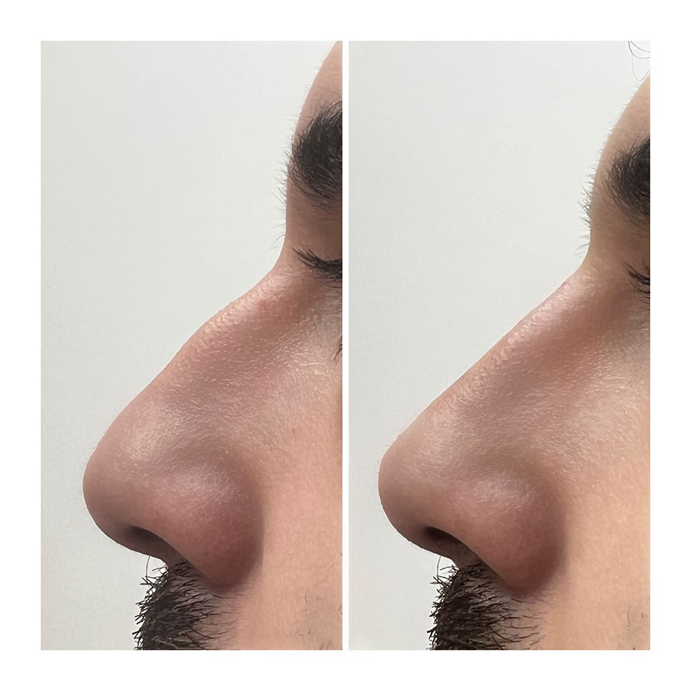 nonsurgical nose job rhinoplasty juvederm in corona, ca