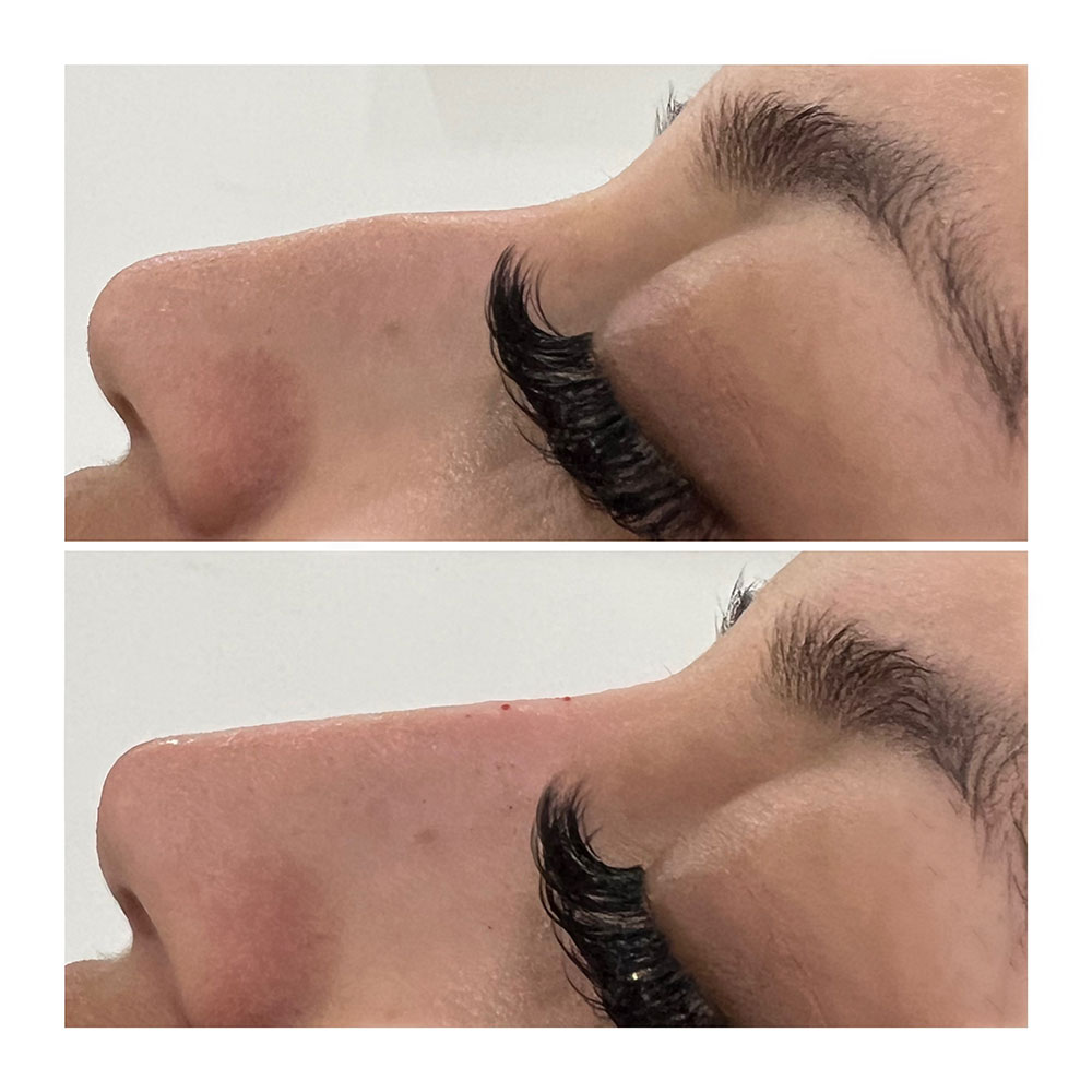 nonsurgical nose job rhinoplasty Juvéderm in corona, ca