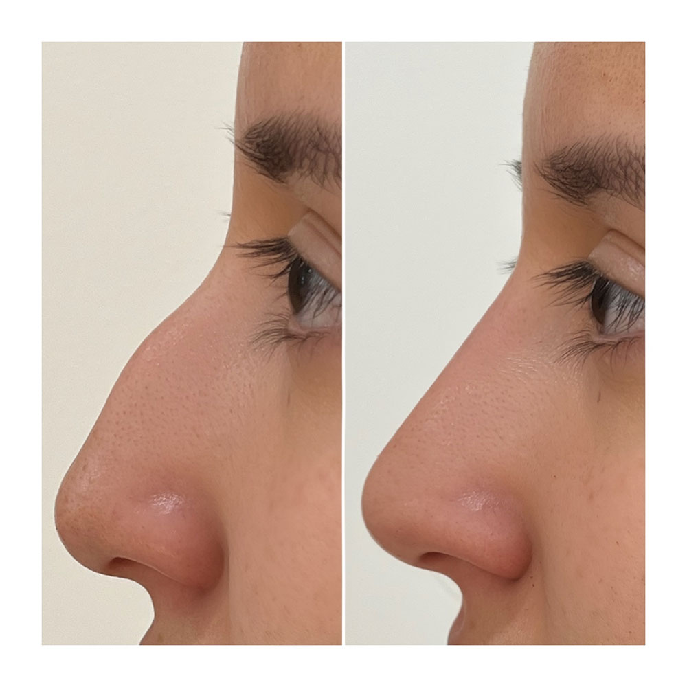 nonsurgical nose job rhinoplasty Juvéderm in corona, ca