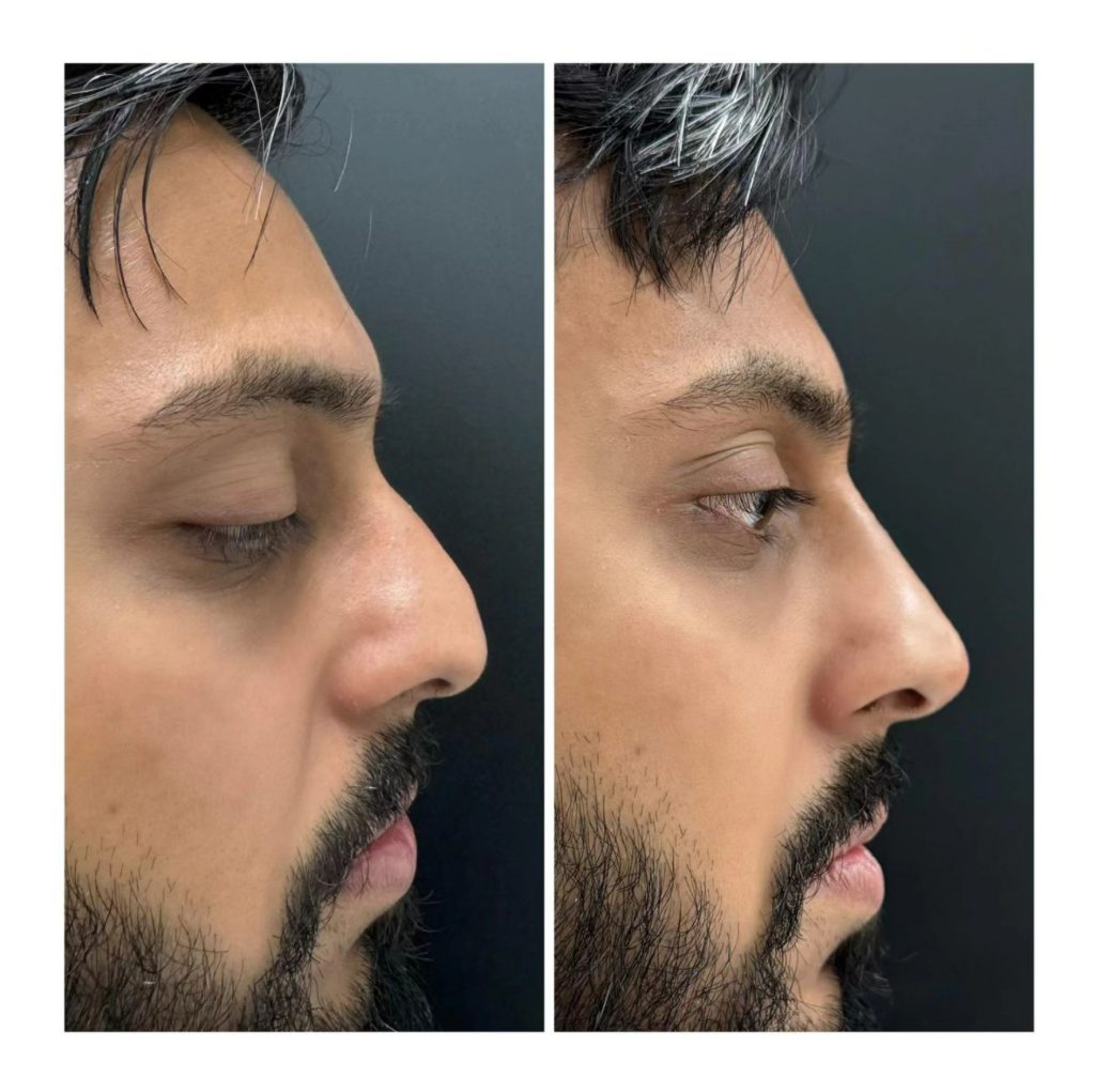 non-surgical-nose-job-in-corona-ca