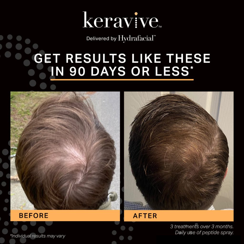 Before and after of male scalp using keravive scalp treatment for 3 months