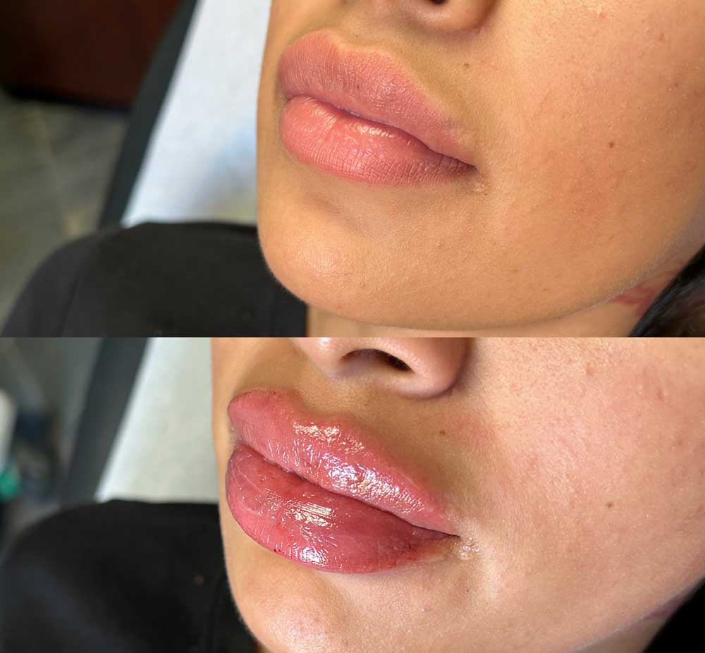 Lip fillers before and afters by the body bar medical spa in Corona, ca 6/10