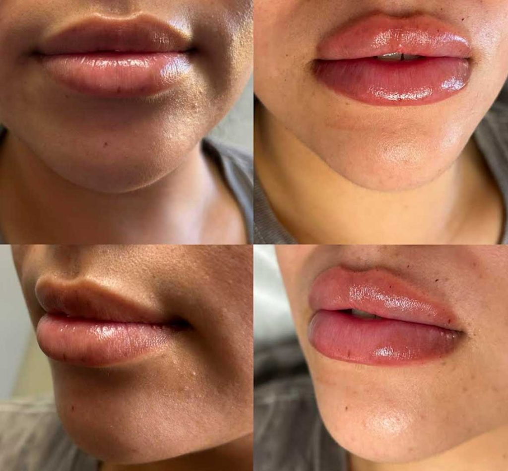 Lip fillers before and afters by the body bar medical spa in Corona, ca 5/10