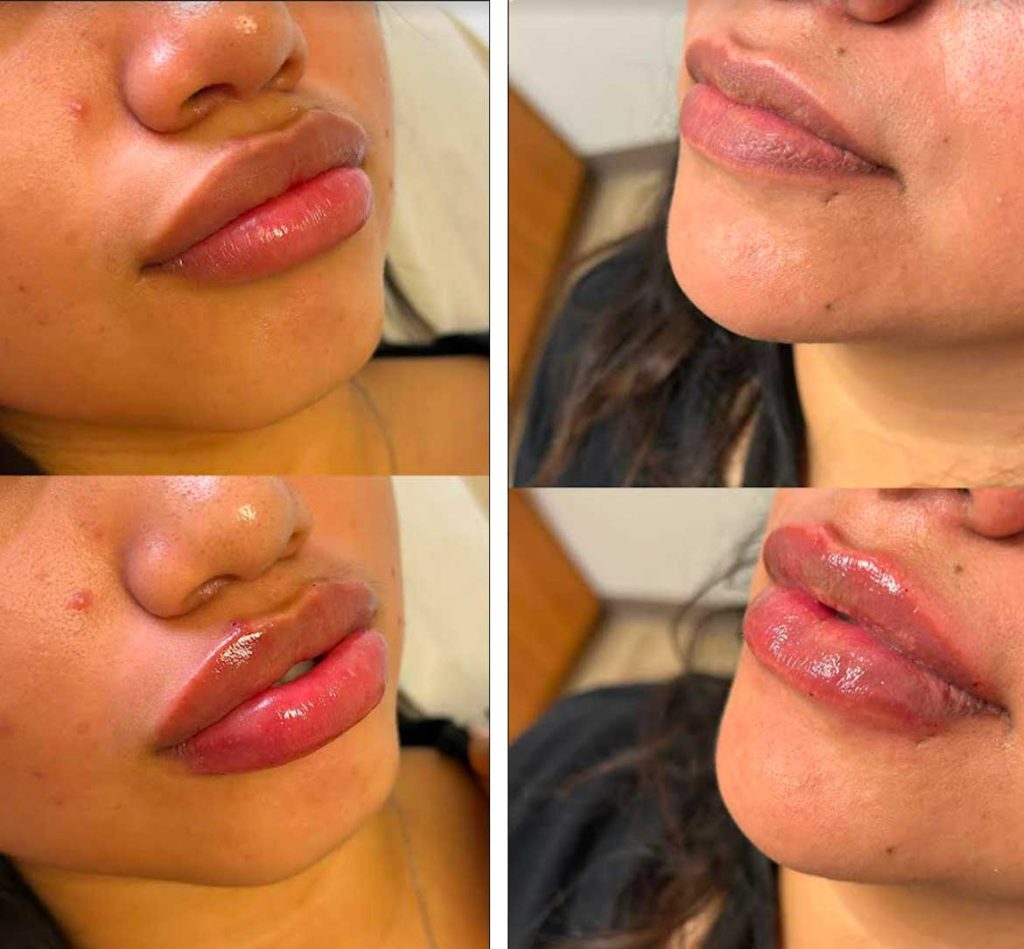 Lip fillers before and afters by the body bar medical spa in Corona, ca 10/10