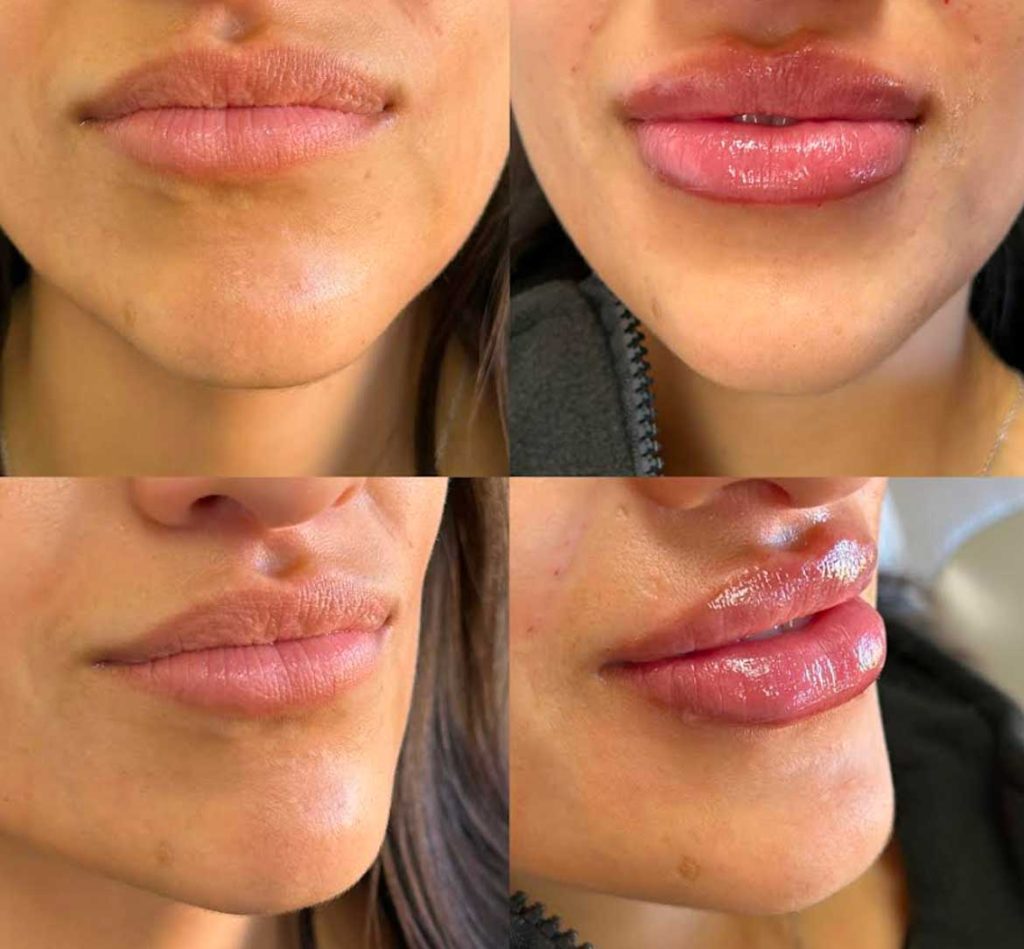 Lip fillers before and afters by the body bar medical spa in Corona, ca 7/10