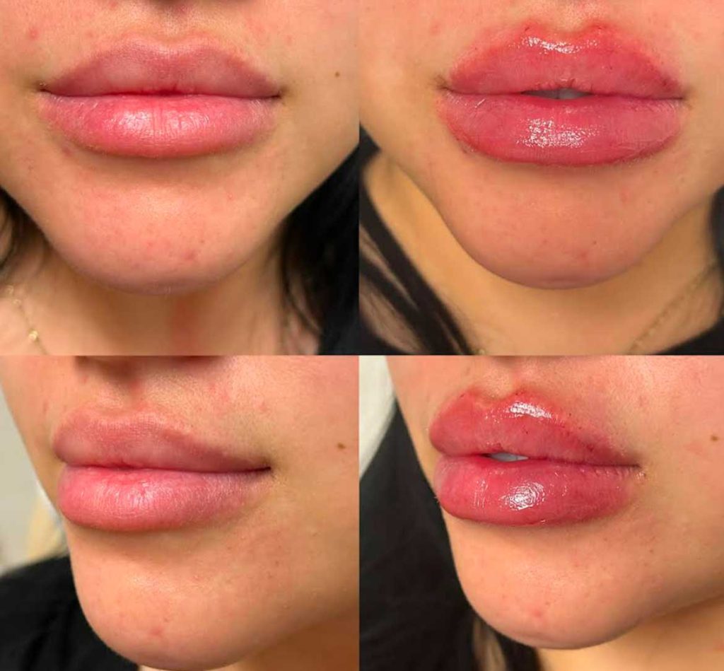 Lip fillers before and afters by the body bar medical spa in Corona, ca 9/10