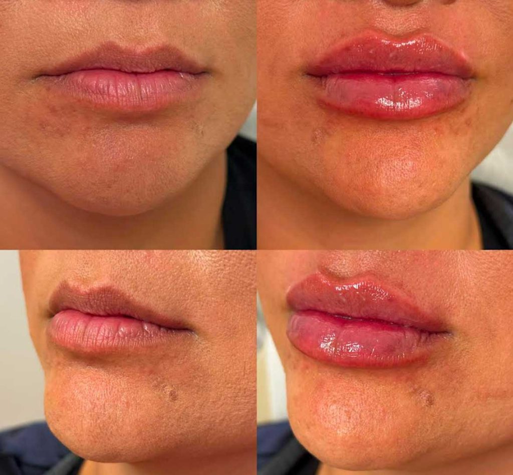 Lip fillers before and afters by the body bar medical spa in Corona, ca 8/10