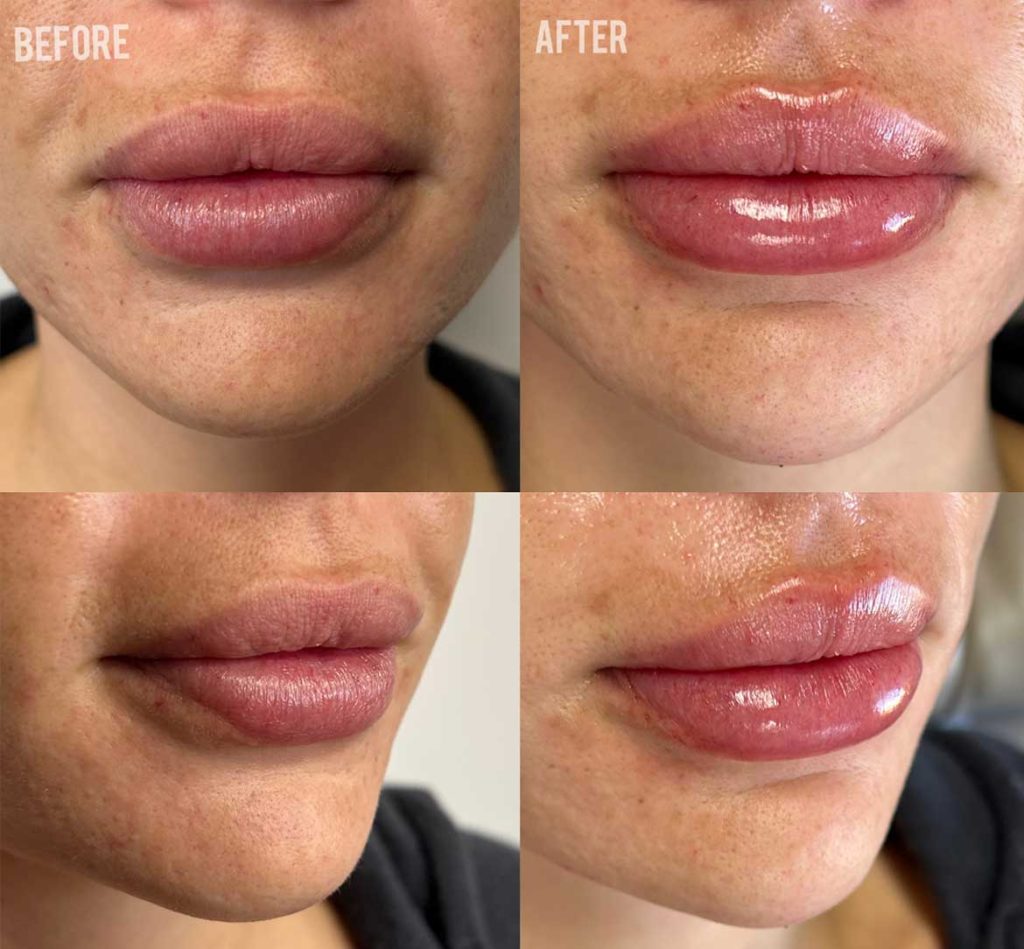 Lip fillers before and afters by the body bar medical spa in Corona, ca 4/10