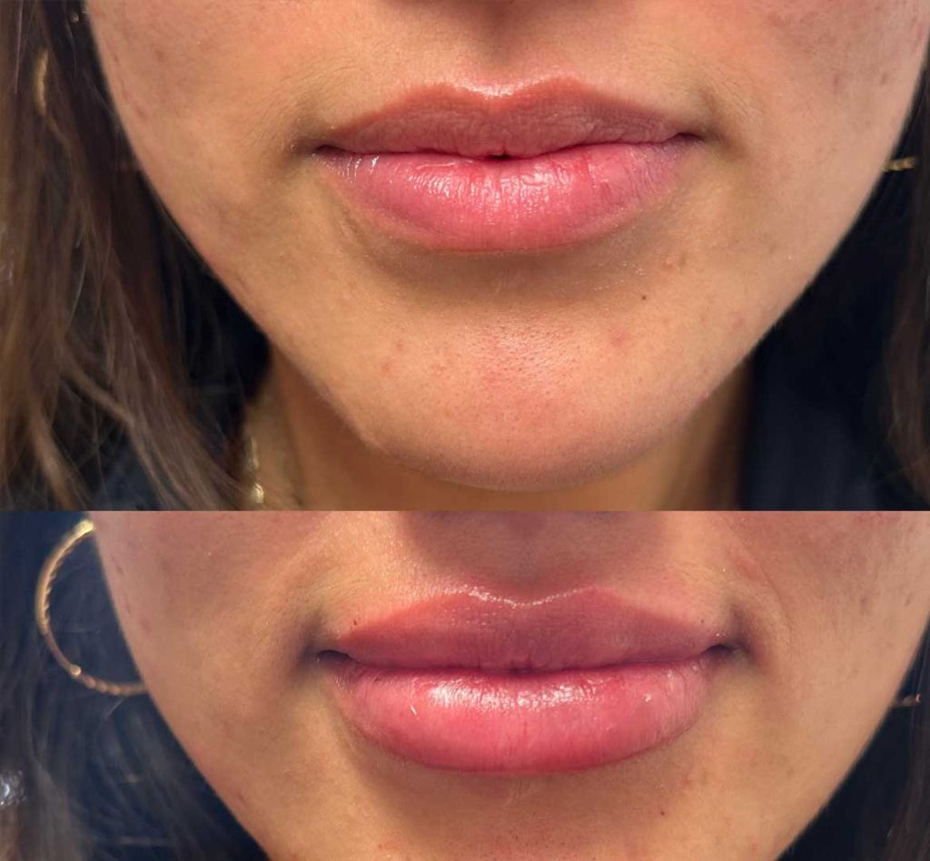 Lip fillers before and afters by the body bar medical spa in Corona, ca 3/10