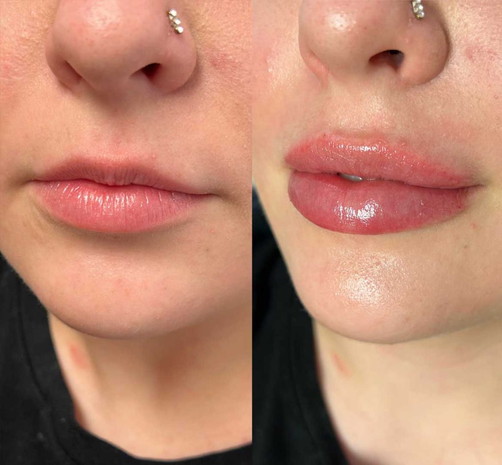 Lip fillers before and afters by the body bar medical spa in Corona, ca 2/10