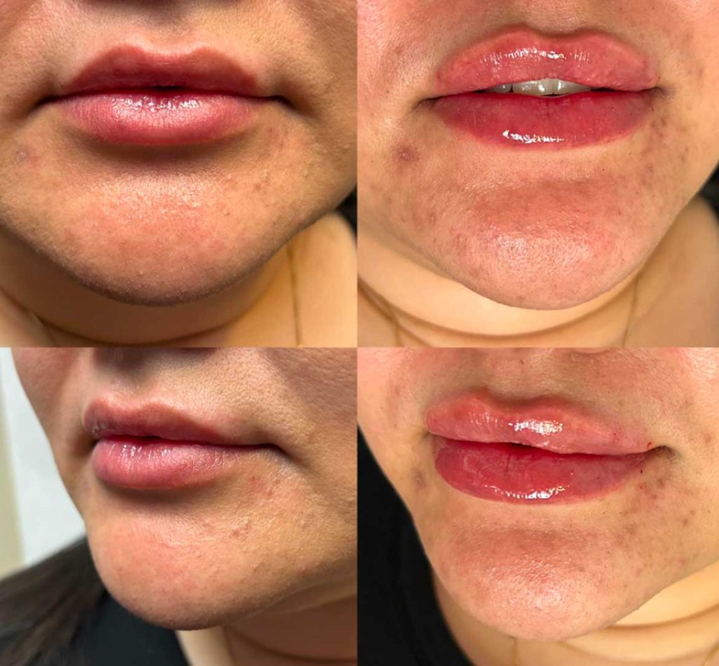 Lip fillers before and afters by the body bar medical spa in Corona, ca 11/14