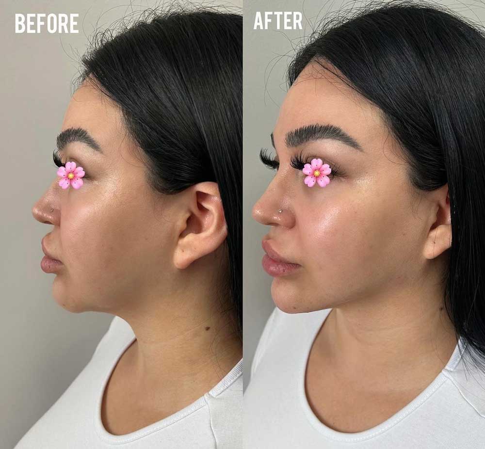 Facial balancing before and after side view patient2