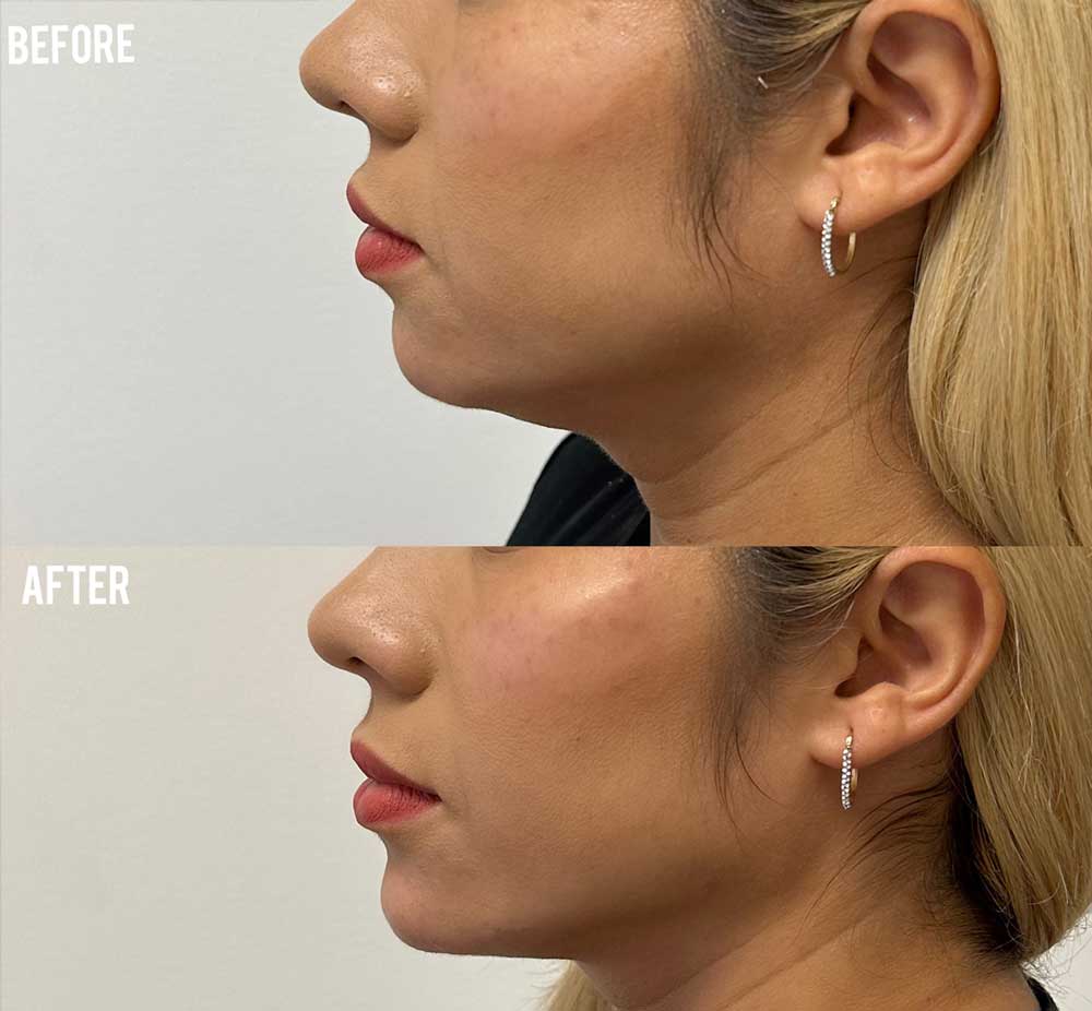 Facial balancing before and after side view patient3