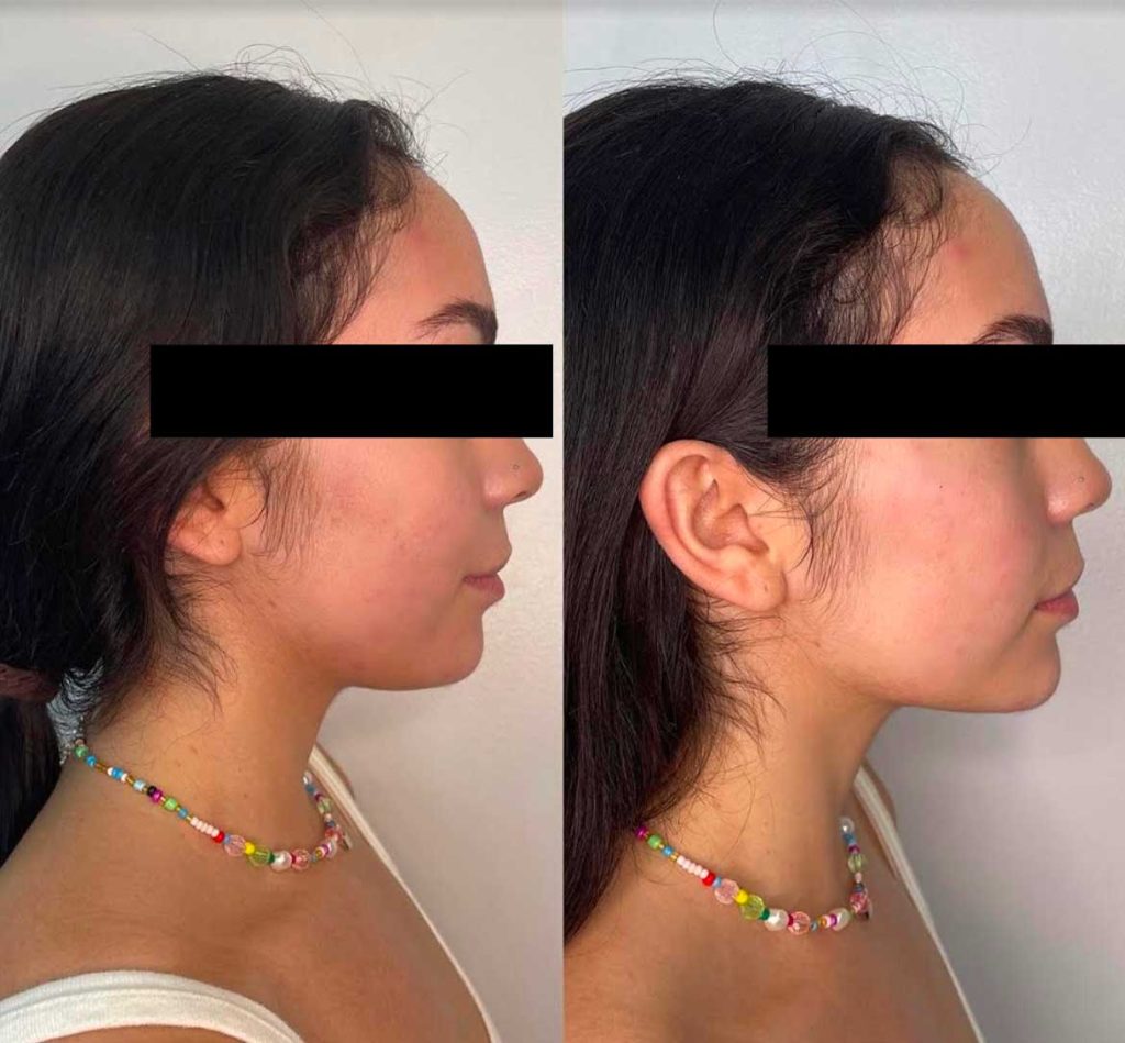 Facial balancing before and after side view