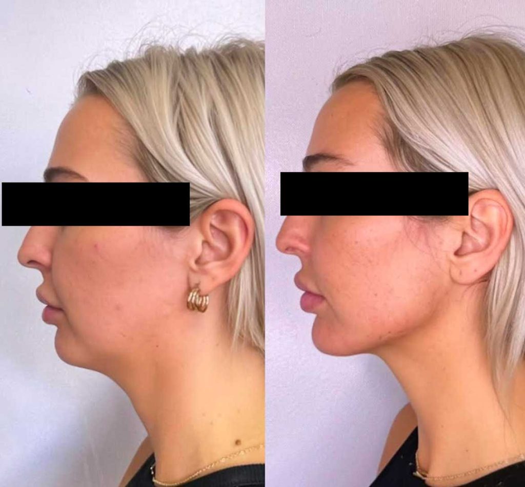 Facial balancing before and after side view patient 4