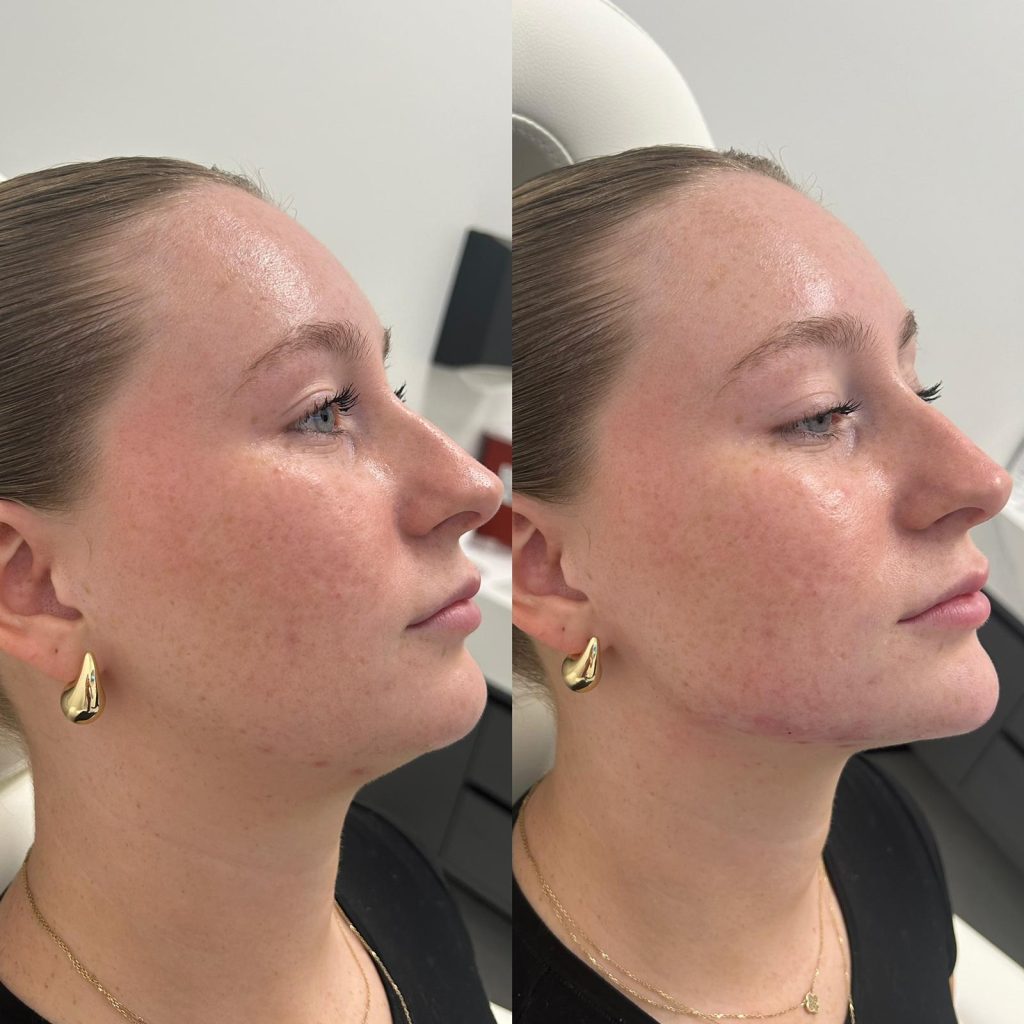 female before and after for facial balancing with chin fillers, jawline filler, and minor cheek fillers by the body bar medical spa in corona ca