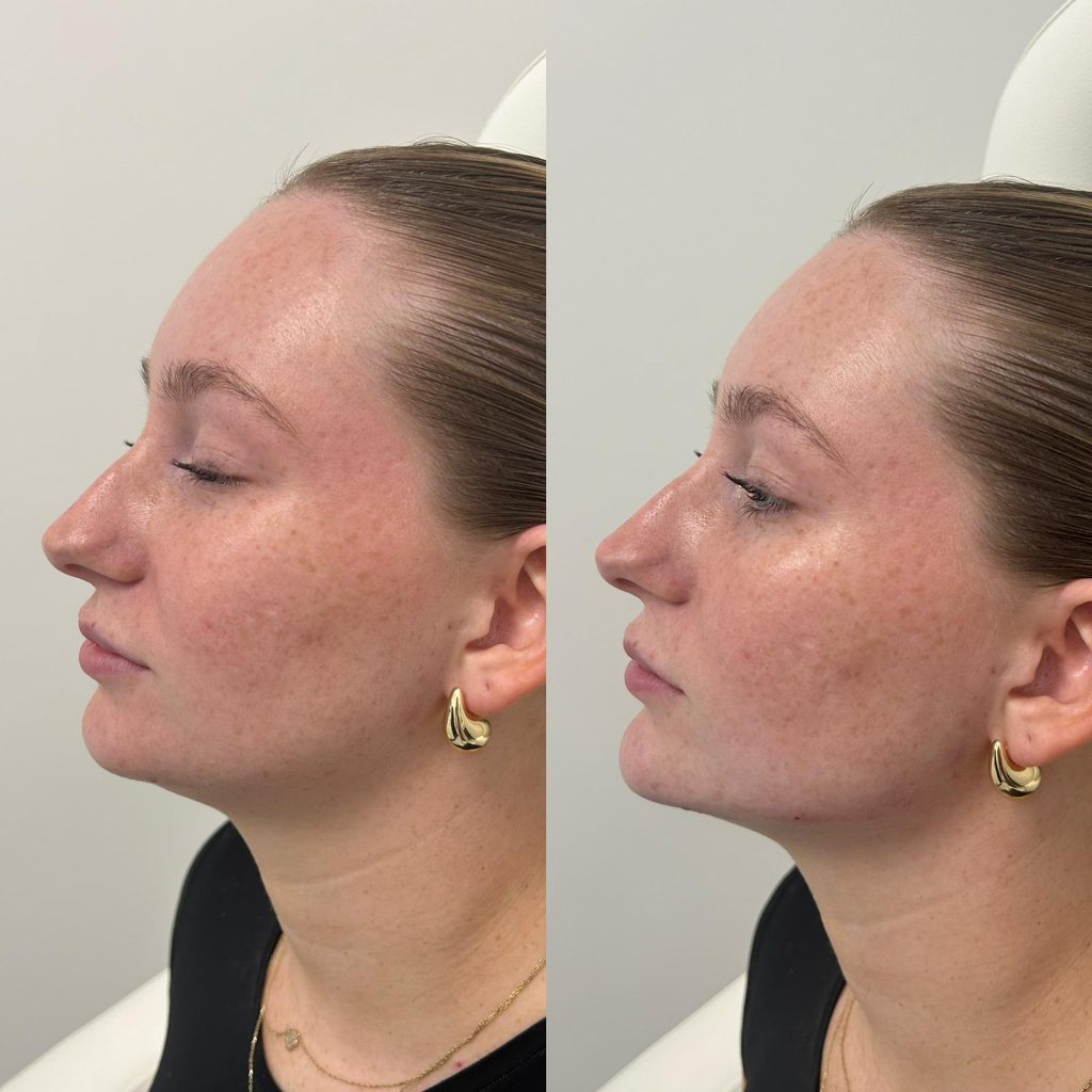 female before and after for facial balancing with chin fillers, jawline filler, and minor cheek fillers by the body bar medical spa in corona ca - other side results