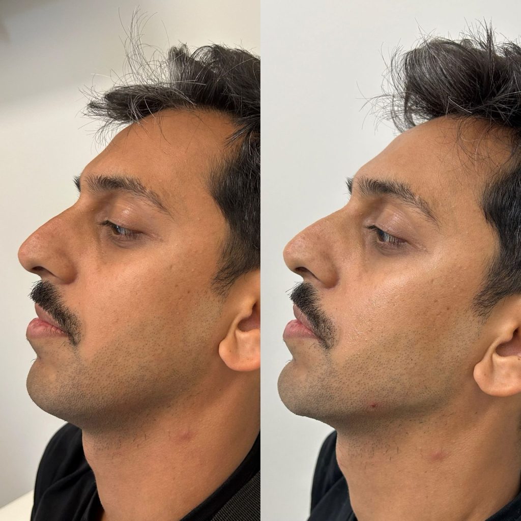 young male before and after for facial balancing with chin fillers, jawline filler, and minor cheek fillers by the body bar medical spa in corona ca