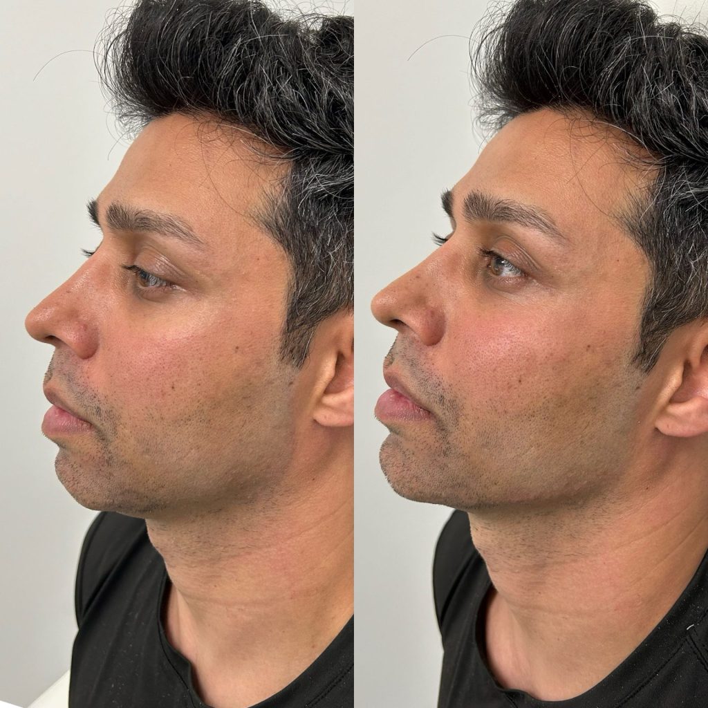 Male before and after for facial balancing with chin fillers, jawline filler, and minor cheek fillers by the body bar medical spa in corona ca