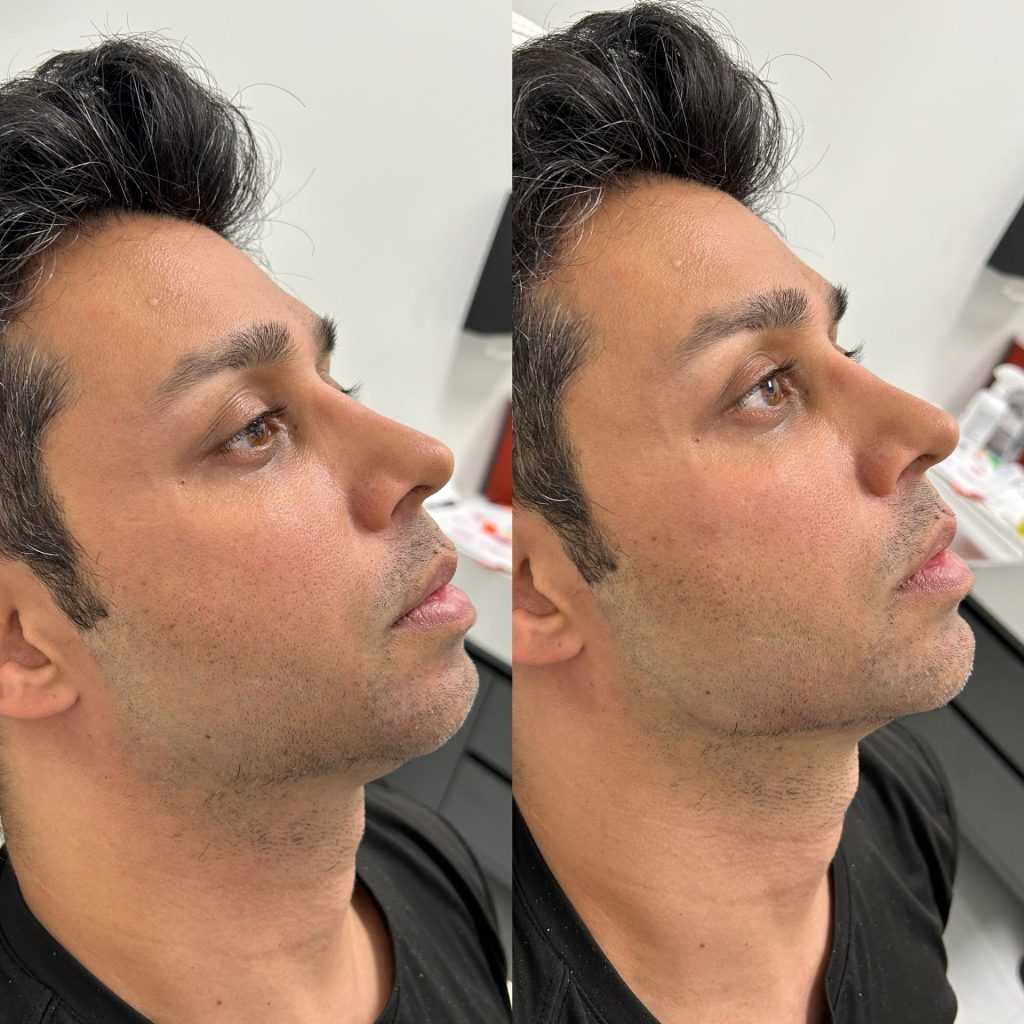 Male before and after for facial balancing with chin fillers, jawline filler, and minor cheek fillers by the body bar medical spa in corona ca - other side results