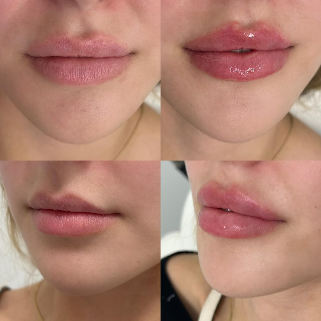 The body bar medical spa lip fillers before and after female 2