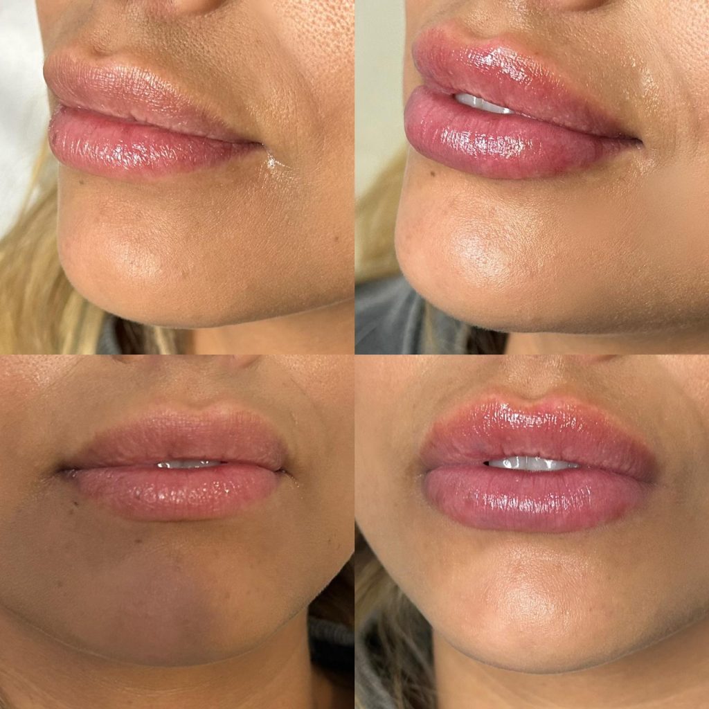 The body bar medical spa lip fillers before and after female 1