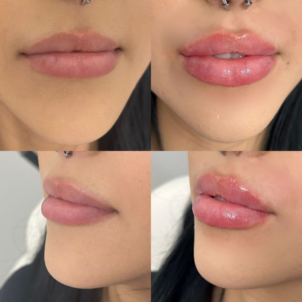 The body bar medical spa lip fillers before and after female 3