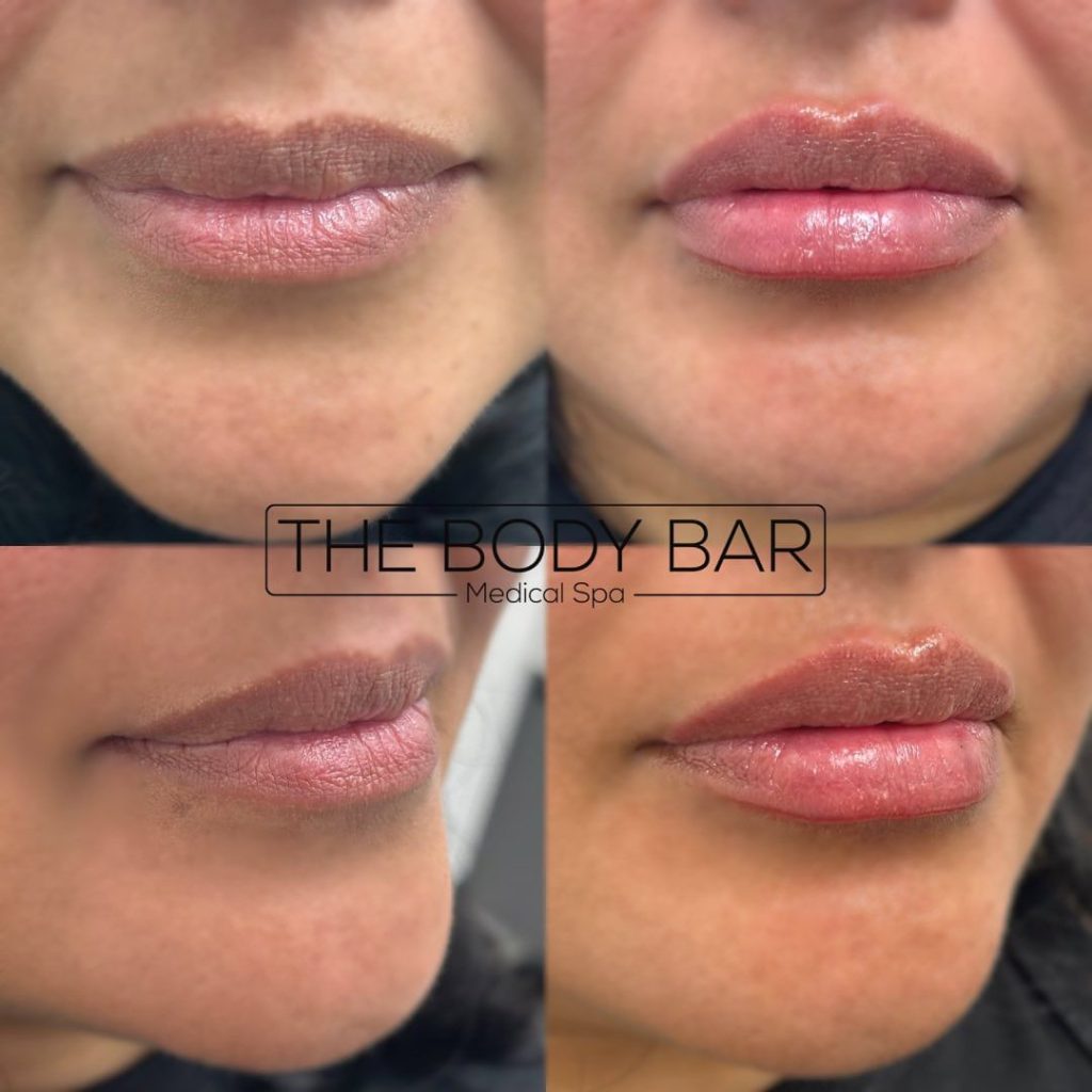 The body bar medical spa lip fillers before and after female 4