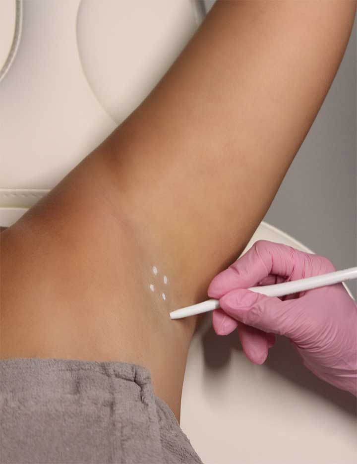 Underarm Sweating Toxin Treatment by the body bar medical spa in corona ca