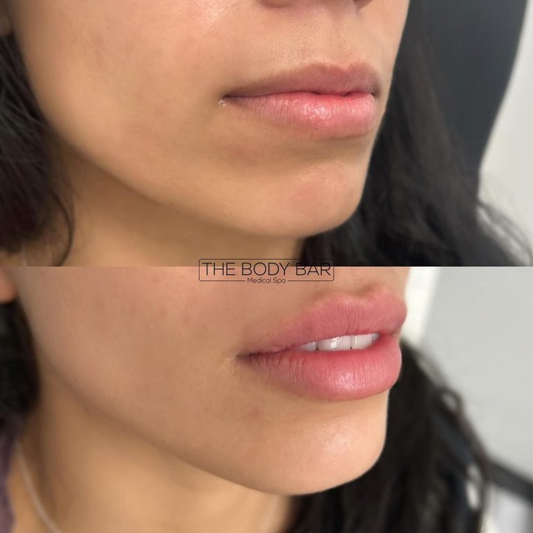 Lip fillers female before and after the body bar medical spa