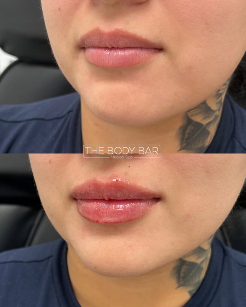Lip fillers before and after by the body bar medical spa in corona ca female model patient 16