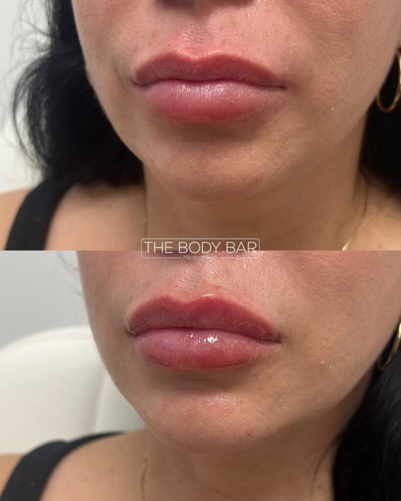 Lip fillers before and after by the body bar medical spa in corona ca female model patient 13