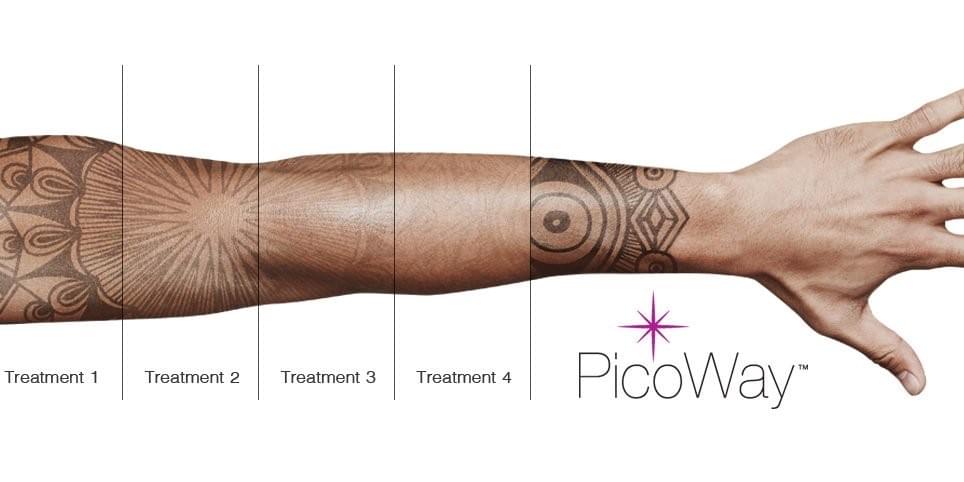 Picoway laser tattoo removal front page image