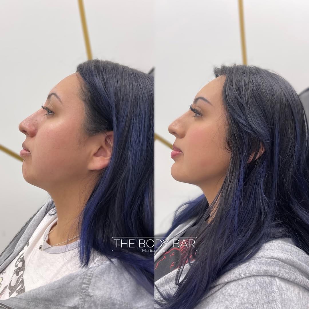 Lipo B12 Shots