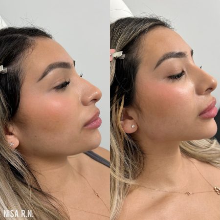 Female facial balancing before and after at the body bar medical spa in corona ca