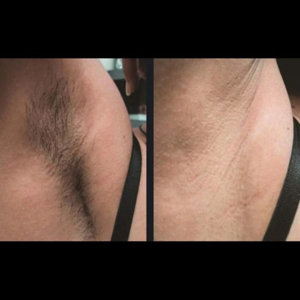 gentle-hair-removal-candela-p2.jpg