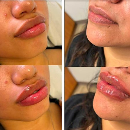 Lip fillers before and afters by the body bar medical spa in Corona, ca 10/10